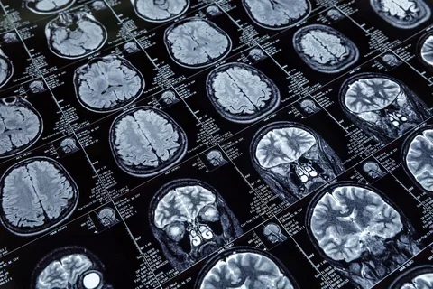 brain scans