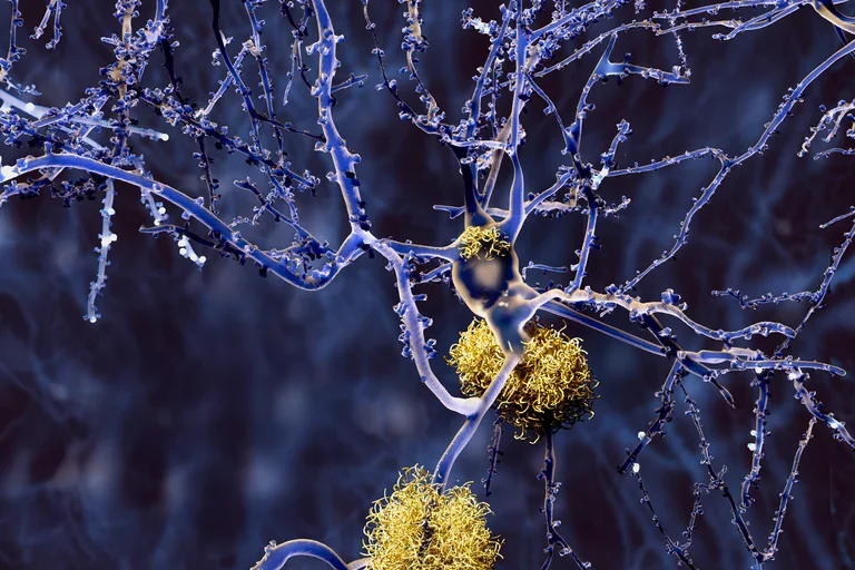 AI generated neurons and amyloid-plaques.
