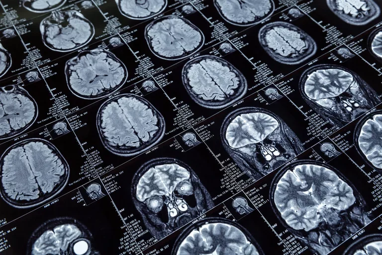 brain scans