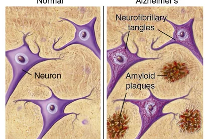Plaques and tangles